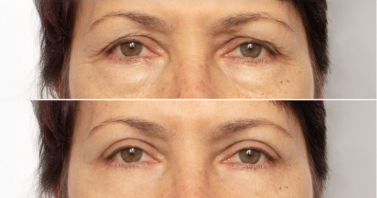 goz-kapagi-dusuklugu