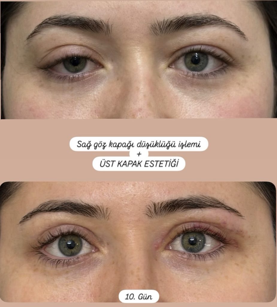 Tek Taraflı Göz Kapağı Düşüklüğü Neden Olur? Tedavisi Nasıl Yapılır? 1 Tek taraflı göz kapağı düşüklüğü
