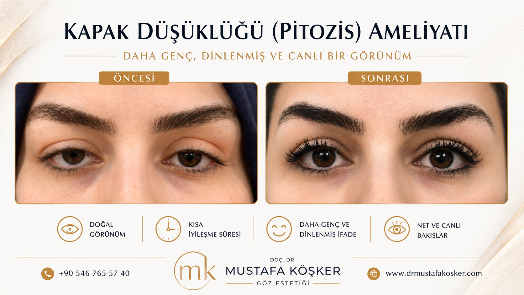 Göz Kapak Düşüklüğü Neden Olur?