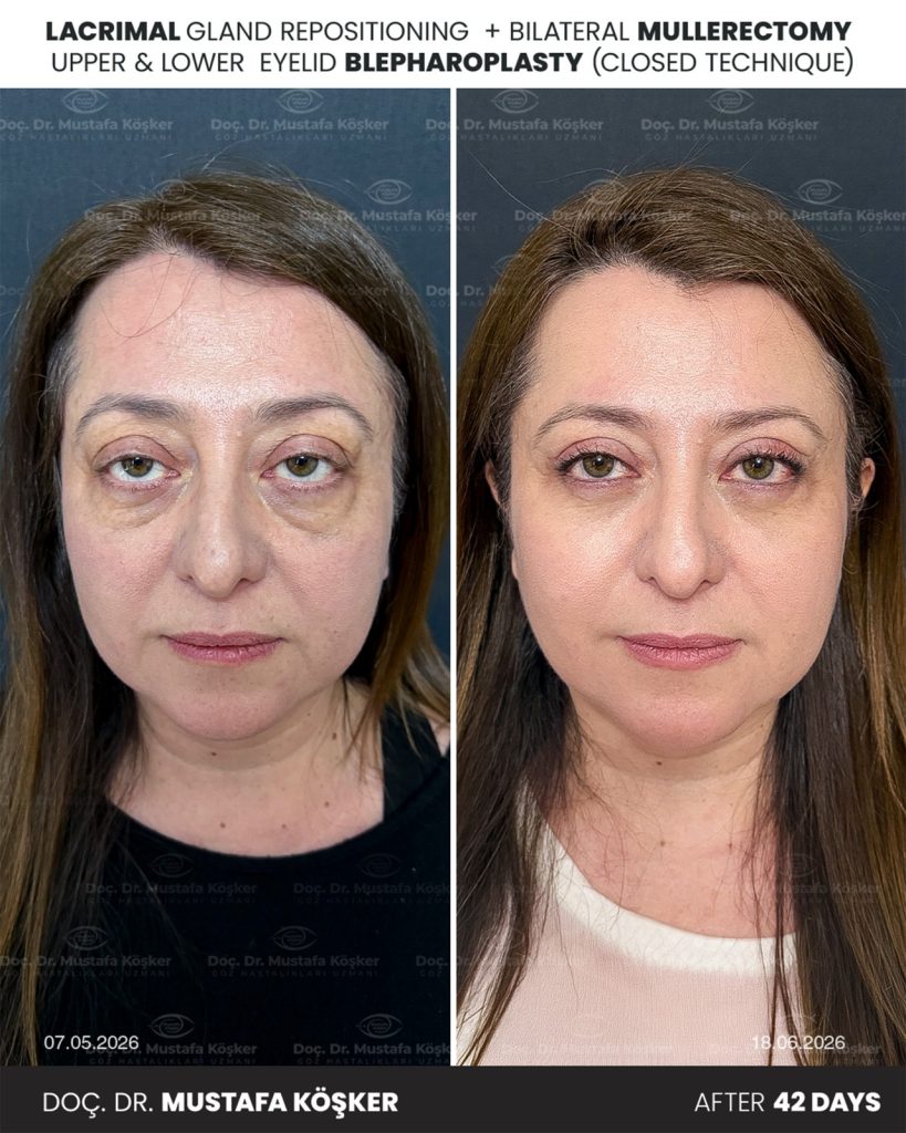 Göz Kapağı Ameliyatı Fiyatları Neye Göre Değişir? 2 Göz KapağıDüşüklüğü Ameliyat Fiyatları 2026
