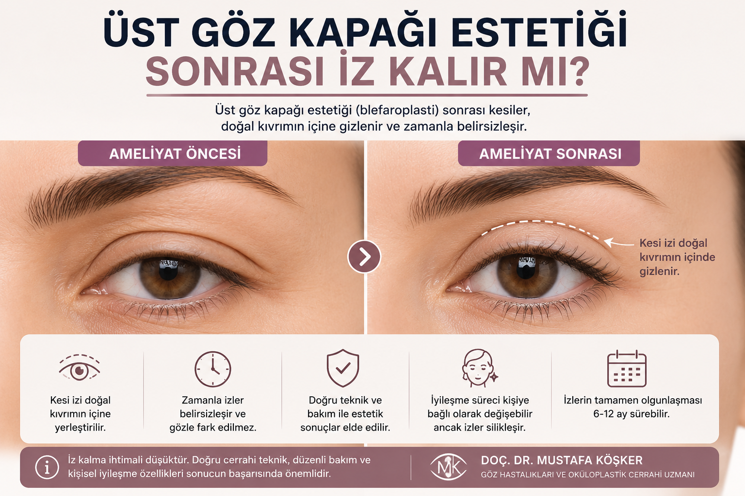 Ust goz kapagi estetigi sonrasi iz kalir mi Blefaroplasti sonrasi kesi izinin dogal goz kapagi kivriminda gizlenmesini gosteren gorsel