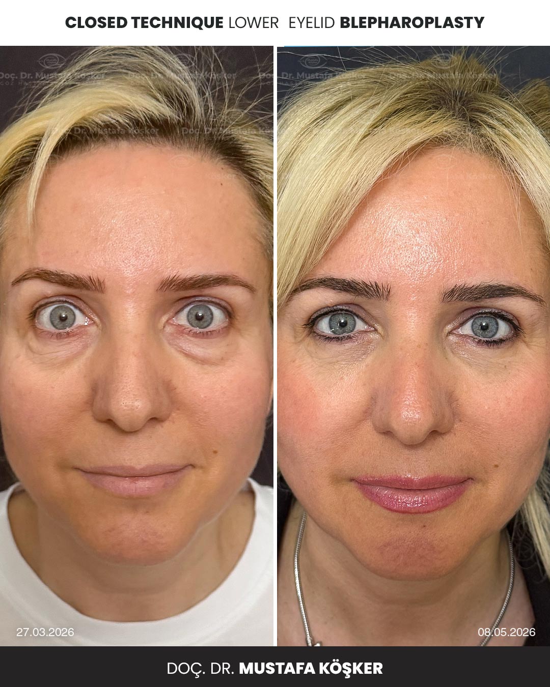 Göz Altı Torbası Ameliyatı 3 closed technique lower eyelid blepharoplasty 8 10 2026 w3