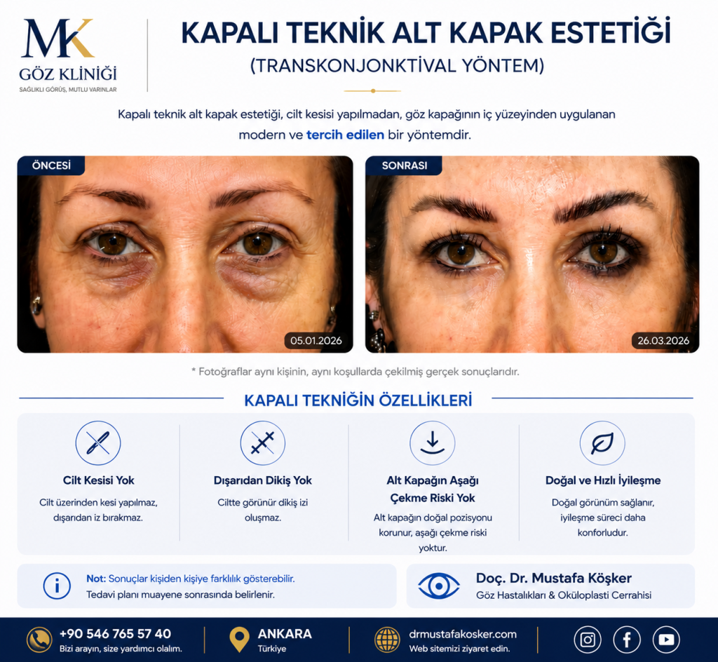 Kapalı Teknik Alt Kapak Estetiği 1 alt kapak estetiği